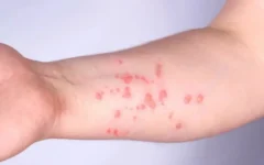 SP registra 44 casos confirmados de mpox em 2026